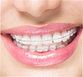 ceramic braces